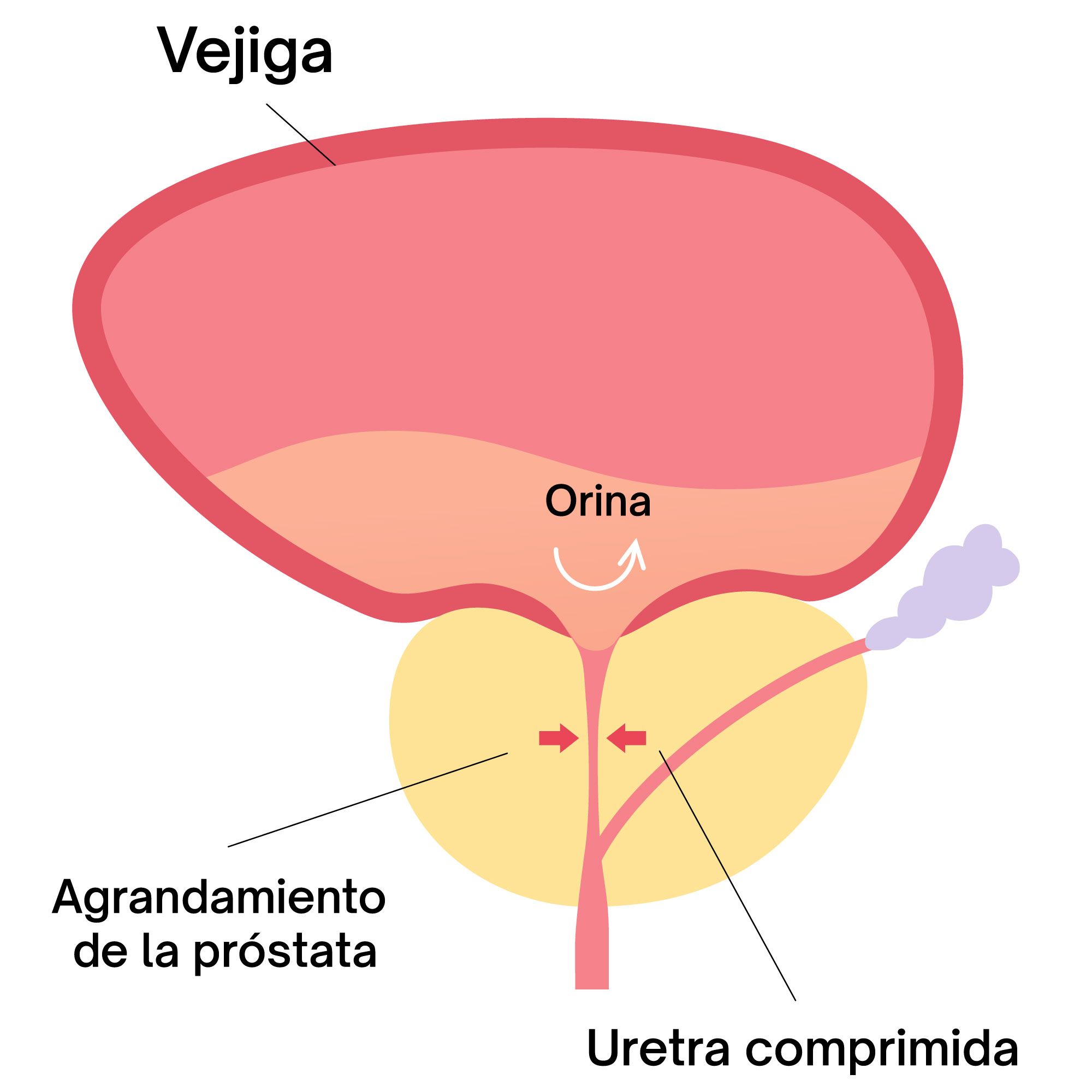 Hiperplasia Prost tica UROLOG A MH Hiperplasia Prost tica UROLOG A MH