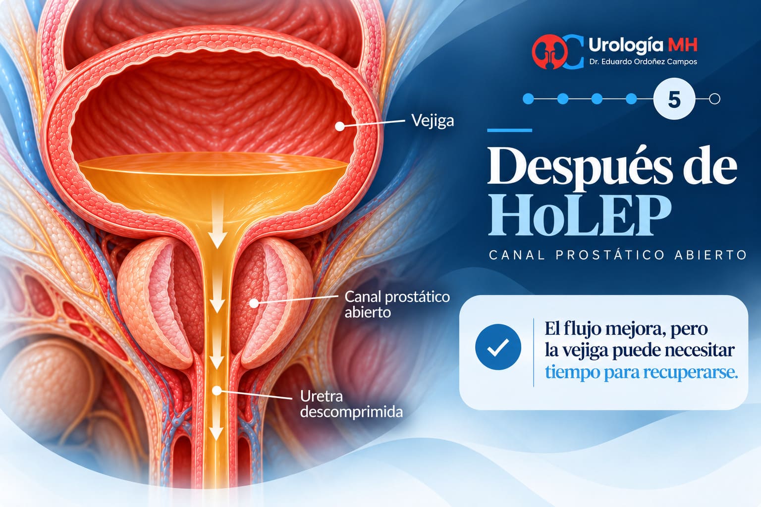 Canal prostático abierto después de HoLEP con uretra descomprimida