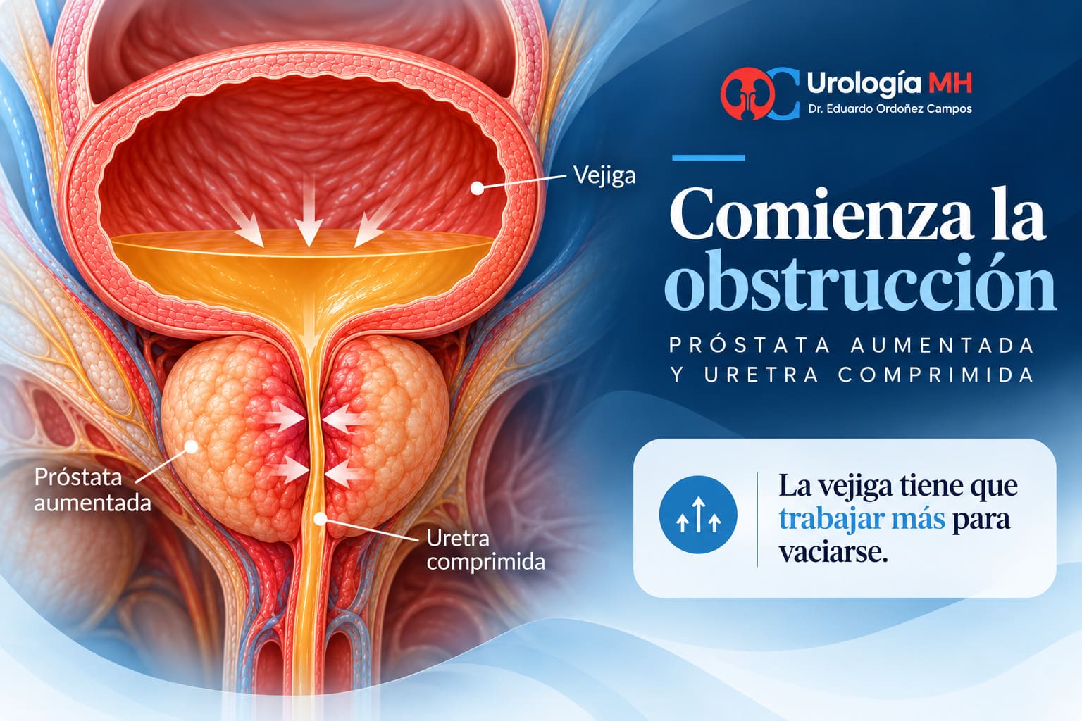 Próstata aumentada que comprime la uretra y dificulta el vaciado de la vejiga