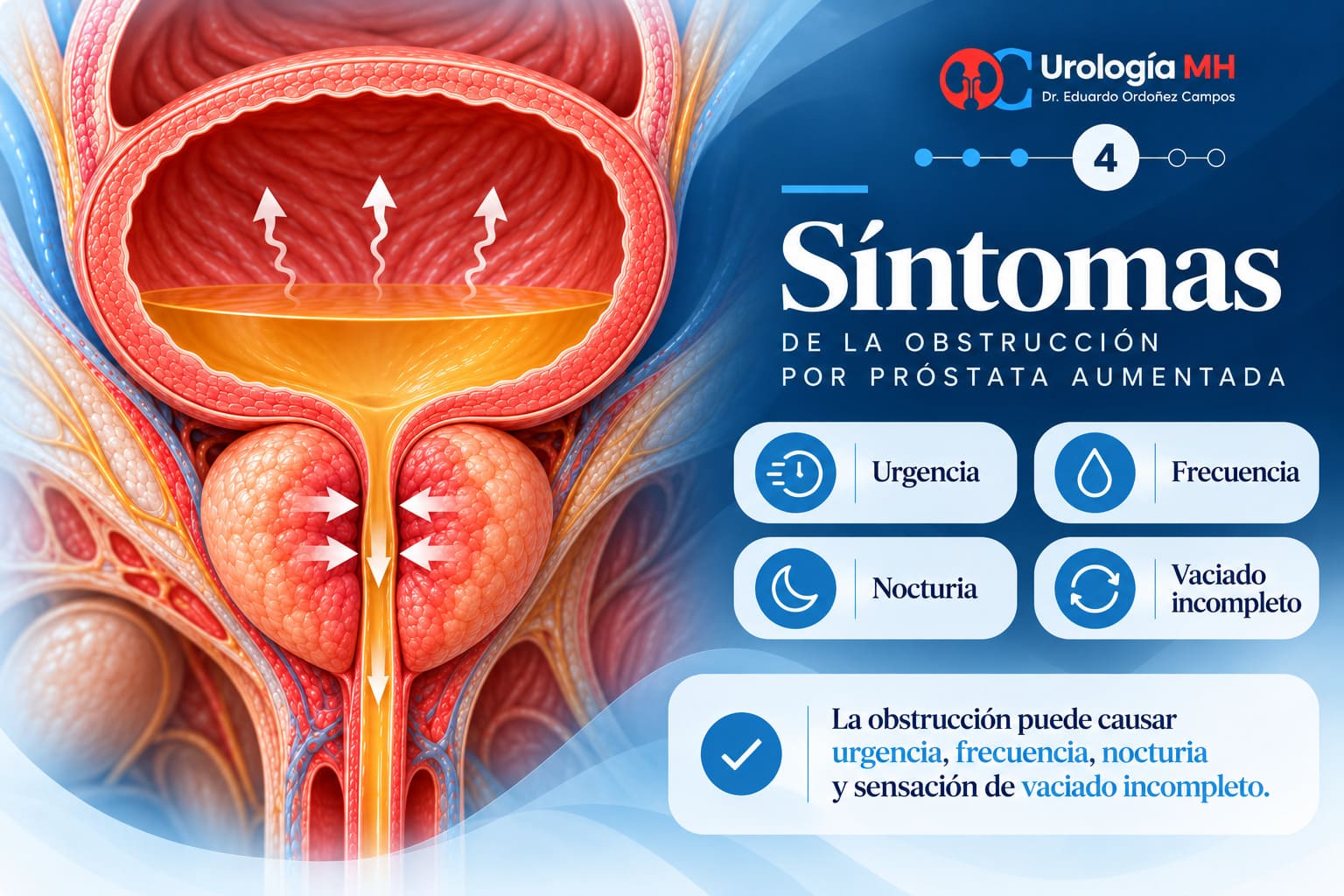 Urgencia frecuencia nocturia y vaciado incompleto por obstrucción prostática