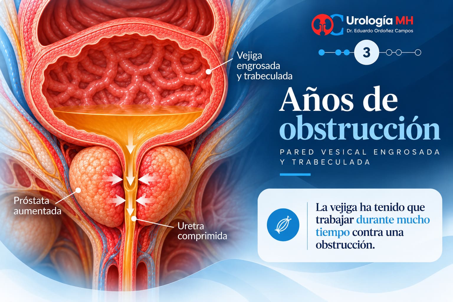 Vejiga engrosada y trabeculada por obstrucción prostática mantenida